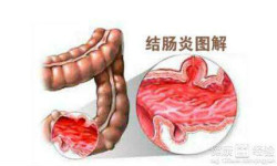 结肠炎危害大，及时检查和治疗！